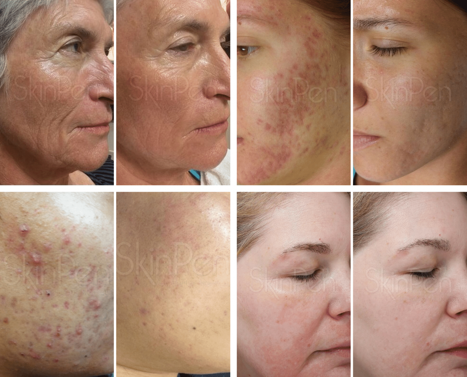 Microneedling for acne, ageing, pigmentation, wrinkles, scars, large pores and uneven skin texture. Now at beYOUtee by Lisa-Marie.