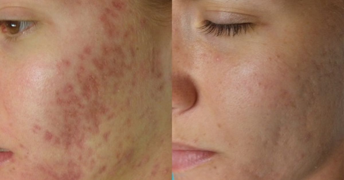 SkinPen Microneedling | New Client Offer