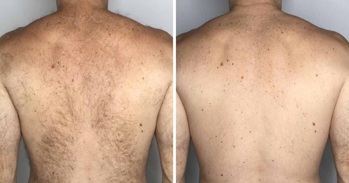 Male back laser hair removal before and after results in Colchester.